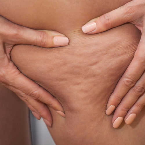 Impacchi per la cellulite