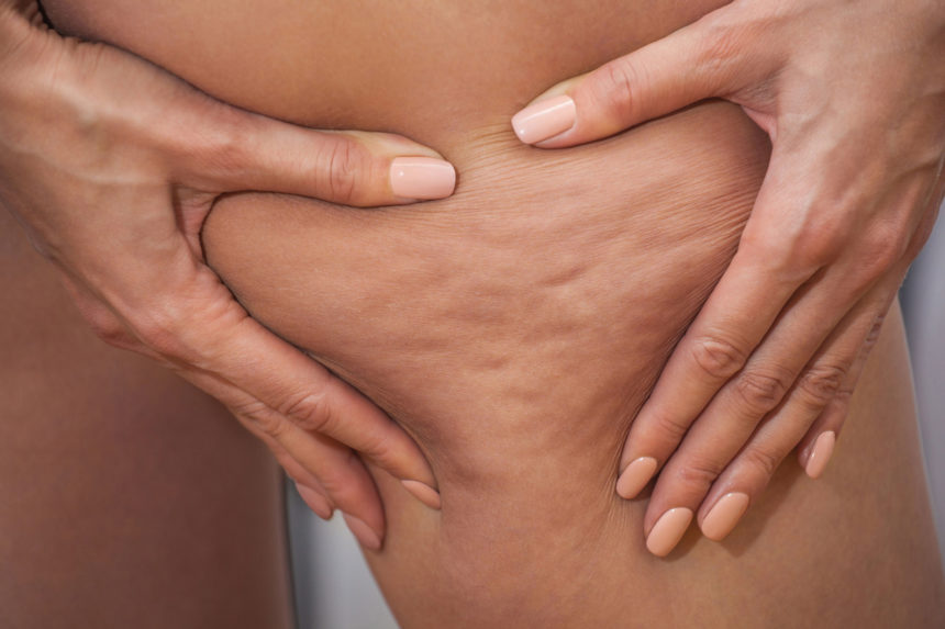 Cellulite: glutei, cosce e adiposità localizzate