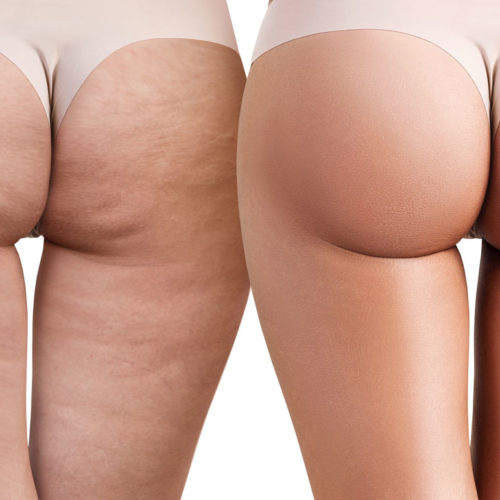 Ridurre la cellulite