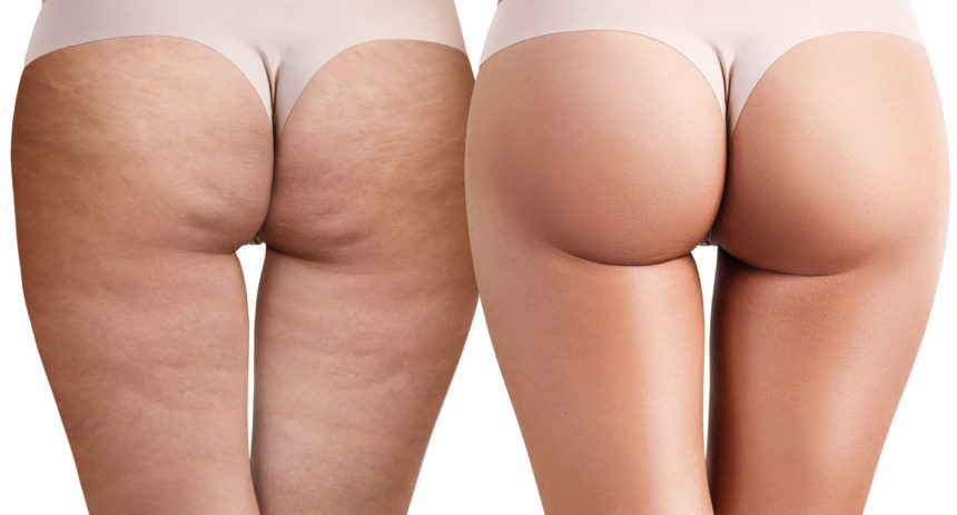 Ridurre la cellulite