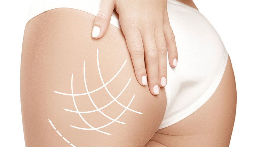 La cellulite che cos’è ?