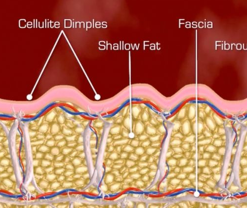 Setti fibrosi e cellulite